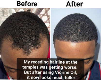 ✨ Ends Today: 70% OFF! 🌿100% pure Batana oil for promoting Hair Growth, Nourishing the scalp